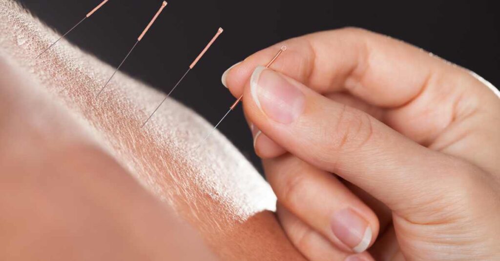 Acupuncture for Pain Relief