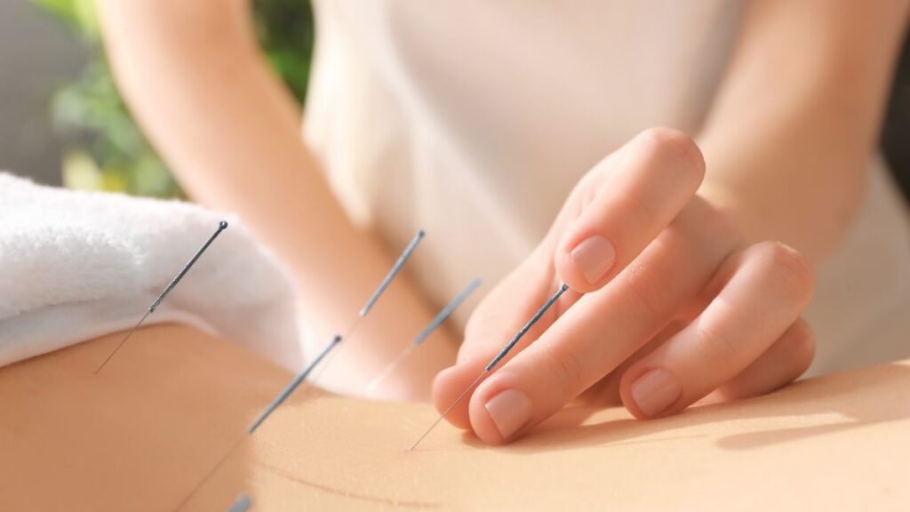 A person receiving acupuncture therapy from a qualified practitioner.